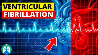 Ventricular Fibrillation Vfib  Medical Explainer Video [upl. by Ahsimac182]