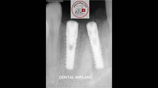 DENTAL IMPLANT  RADIOGRAPHIC OF DENTAL IMPLANT PLACED INTO UPPER JAW [upl. by Nnaes]