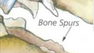 Bone spursarggggg [upl. by Kono]