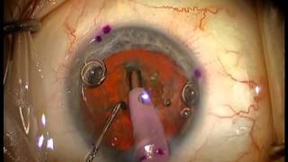 Cataract Surgery for Astigmatism  Toric Intraocular Lens Implantation [upl. by Reyotal887]