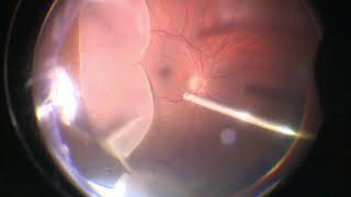 Vitrectomy for Giant Retinal Tear  Retinal Detachment  GRT  Dr Manish Nagpal [upl. by Dulce]