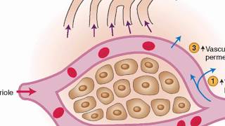 Mechanisms of edema development [upl. by Renault333]