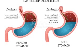 GASTROOESOPHAGEAL REFLUX DISEASE GERD  PATHOPHYSIOLOGY [upl. by Anauqed]