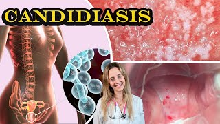 CANDIDIASIS VAGINAL CAUSAS SÍNTOMAS DIAGNÓSTICO Y TRATAMIENTO  Dra Aperpin [upl. by Bartolomeo]