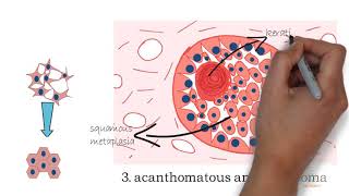 Ameloblastoma part 2 [upl. by Dugald]