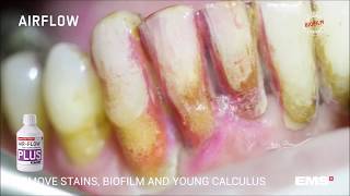 GBT Step 04 Stains biofilm and young calculus removal with AIRFLOW® and PLUS powder [upl. by Lednic]