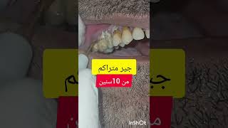 ازالة وتنظيف جير و تقليح الاسنان dentist stitch اكسبلور stitchlover ترند [upl. by Lazaro]