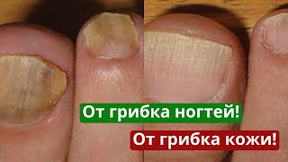 От грибка Ванночка для ног с солью и хлорофиллиптом от грибка на ногтях и на коже [upl. by Diley]