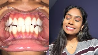 STRAIGHT TEETH IN 6 MONTHS SMILE DIRECT CLUB  MY HONEST OPINION [upl. by Oicirbaf640]