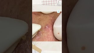 Big Cystic Acne Blackheads Extraction Blackheads amp Milia Whiteheads Removal Pimple Popping shorts [upl. by Kaczer113]