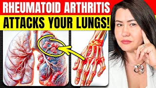 Warning Rheumatoid Arthritis And Lung Problems [upl. by Alil]