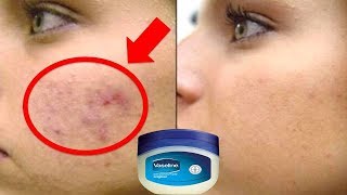 कैसे Vaseline से 3 दिन में चेहरे से दाग धब्बे मुँहासे के निशान झाइयों को गायब करें Vaseline Hacks [upl. by Ponzo]