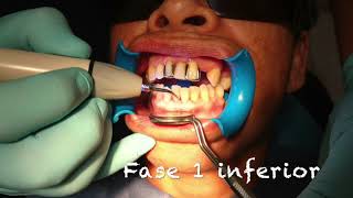 Previo curetaje periodontal [upl. by Eedyaj]