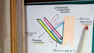 Direct vs Indirect Inguinal Hernia  Malang Medicose [upl. by Celisse754]