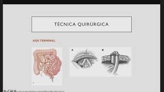 Realización de estomas técnica y controversias [upl. by Anivek176]