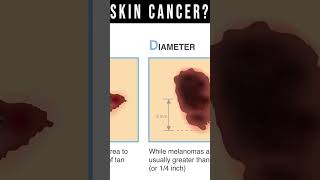 What Does Skin Cancer Look Like Symptoms Pictures Types [upl. by Kenzi]