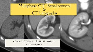 MULTIPHASIC RENAL CECT PROTOCOL  SPLIT BOLUS TECHNIQUE CT UROGRAPHY Triple bolus technique [upl. by Lela]