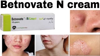 Betnovate C skin cream [upl. by Kristy271]