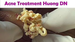 Acne Treatment Huong Da Nang  2024 Acne Huong 715 [upl. by Rayburn776]