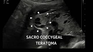 Sacrococcygeal teratoma at 22 weeksFollowup of this case httpsyoutubeYa59lnLs [upl. by Azilanna226]