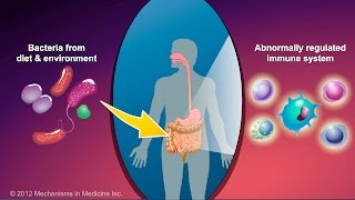 What is Crohns Disease [upl. by Enilarac]