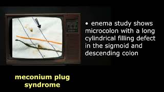 meconium plug syndrome [upl. by Yousuf671]