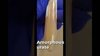 Amorphous urate urine [upl. by Iey173]