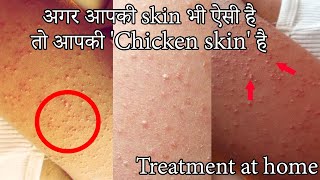 Chicken skin treatment  Alarge body solution in hindi\katha brana treatment \ keratosis pilaris [upl. by Philipson]