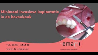 Implantaat implantatie in de kaak [upl. by Virendra611]