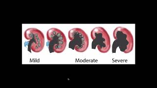 Hydronephrosis  Ultrasound [upl. by Sergu]