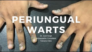 PERIUNGUAL warts [upl. by Koby]