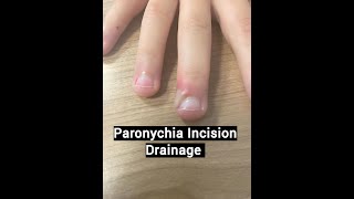 Paronychia Treatment [upl. by Verney]