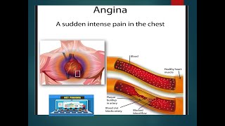 Angina pectoris in hindi [upl. by Nettle100]