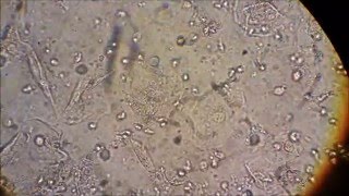 Trichomonas Vaginalis Video [upl. by Kcirddes]