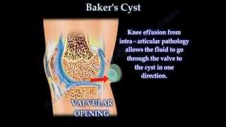 Bakers Cyst  Everything You Need To Know  Dr Nabil Ebraheim [upl. by Veronica]