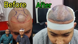 Day 1 After 24 hours HAIR TRANSPLANT🙆‍♂️swelling h thoda sa hairtransplant jobandgame1 [upl. by Edik]