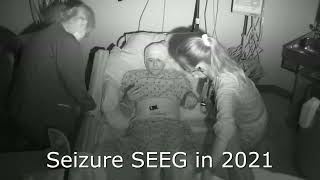 Seizure Clips of Epilepsy Progression [upl. by Anahtor953]