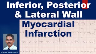 Inferior Posterior and Lateral Wall Myocardial Infarction [upl. by Friedland825]