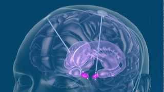 Deep Brain Stimulation  What is DBS [upl. by Apur]