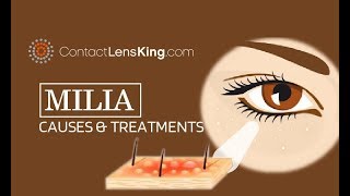 Milia Extraction Causes and Treatment  Milia Under the Eyes [upl. by Armando]