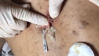 Cystic Acne Treatment  Blackhead Removal  Back Pimple Popping  Hidden Acne Spa Relaxing  096 [upl. by Surat]