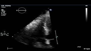 TTE  Renal Cell Cancer in the IVC and right heart [upl. by Sumer]