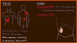 Acute Cholecystitis 23 [upl. by Marj]