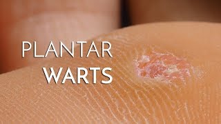 Plantar Warts Verrucas  Podiatrist Georgina Tay East Coast Podiatry [upl. by Lipsey]