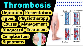 Thrombosis  Thrombosis in hindi  DVT  Thrombosis definition  thrombosis pathology [upl. by Annnora991]