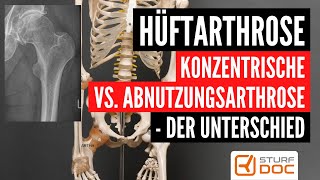 Konzentrische Hüftgelenkarthrose  Die Besonderheiten dieser Arthroseform [upl. by Adila]