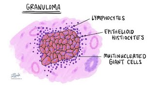 Granuloma Granuloma formation and Examples of disease conditions that are Granulomatous [upl. by Ruperta]