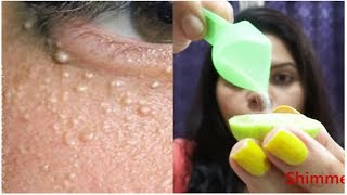 How To Remove MILIA Naturally From FaceOily SkinGet Rid Of MILIA Naturally [upl. by Llenad]