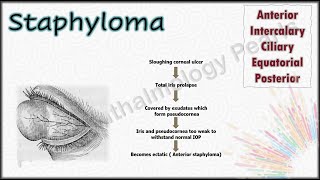 Staphyloma  Undergraduate Examination revision pearls 15 [upl. by Caitrin815]