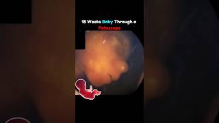 18 Weeks Baby Through Fetoscope 🤩💕 pregnancy fetus [upl. by Wenoa]